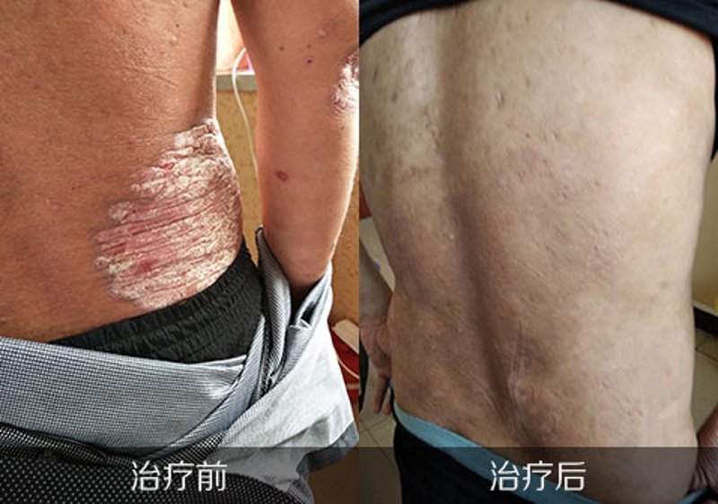 银屑病治疗：最新进展与未来方向