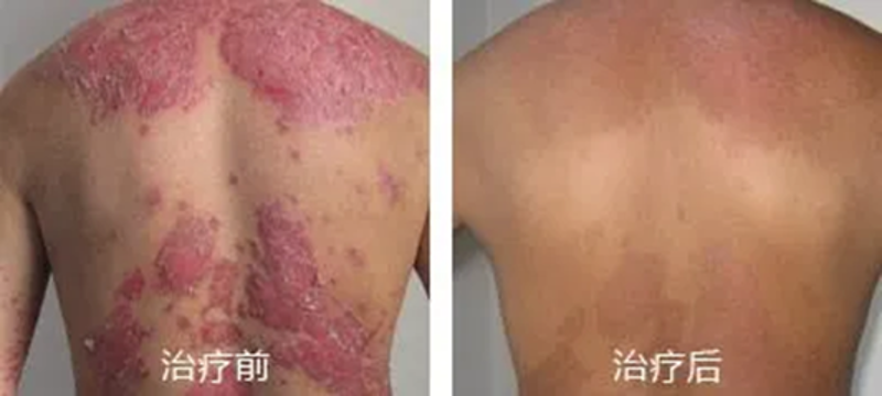 邢台皮肤病医院，您身边的皮肤卫士